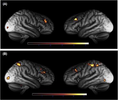 Functional brain alterations in Cushing’s syndrome